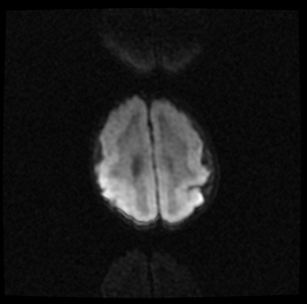 Mucopolysaccharidosis Type I | Image | Radiopaedia.org