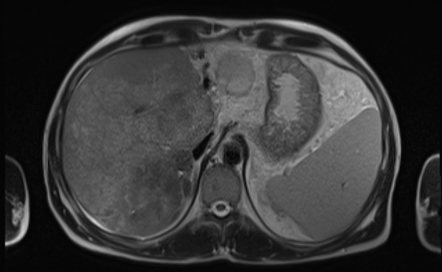 Budd Chiari syndrome | Image | Radiopaedia.org