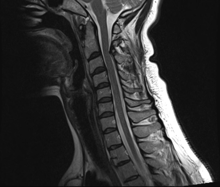 Spina bifida occulta - cervical spine | Image | Radiopaedia.org