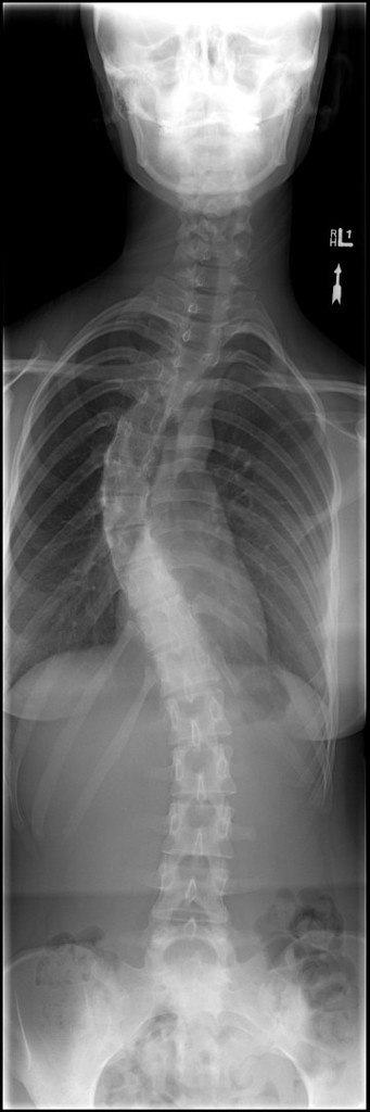 Idiopathic Scoliosis Radiology Case Radiopaedia Org