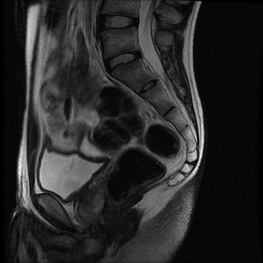 Sacroiliitis | Image | Radiopaedia.org