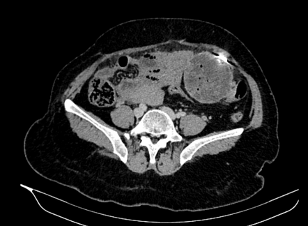 Gossypiboma | Radiology Case | Radiopaedia.org