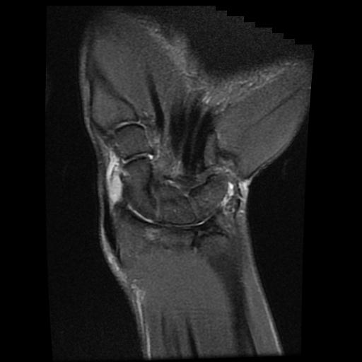 Giant cell tumor of the tendon sheath | Image | Radiopaedia.org