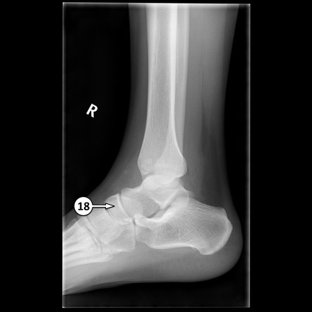 Navicular | Radiology Reference Article | Radiopaedia.org