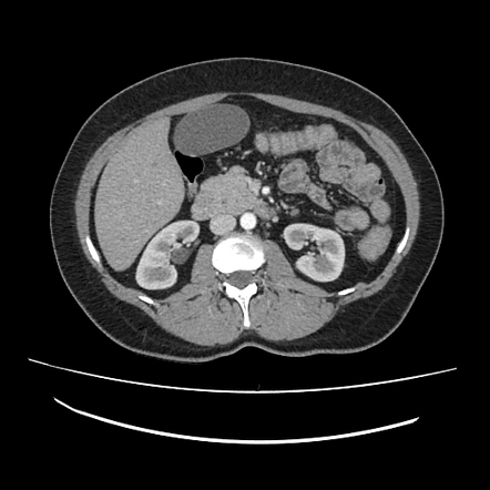 Annular Pancreas Radiopaedia