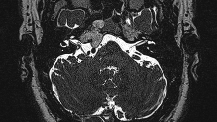 Abducens nerve palsy | Radiology Reference Article | Radiopaedia.org