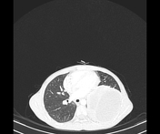 Viewing playlist: Mamdouh Mahfouz - Chest (focal lung lesions ...