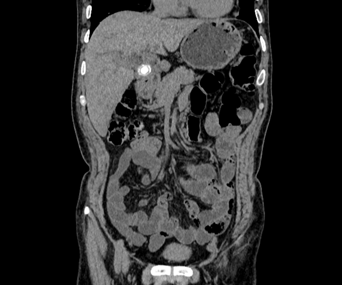 Mirizzi Syndrome Image Radiopaedia Org