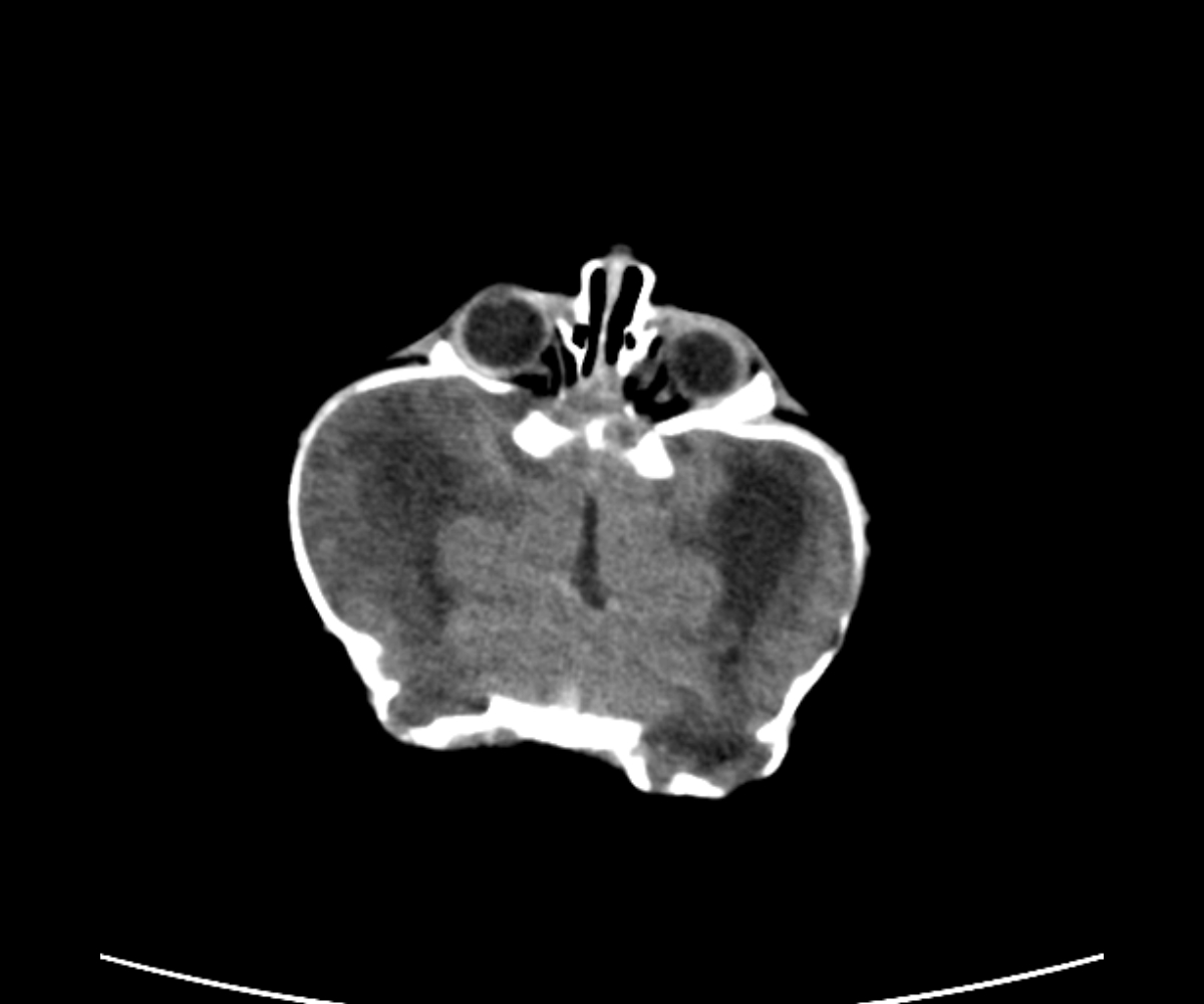 Cloverleaf skull deformity | Image | Radiopaedia.org