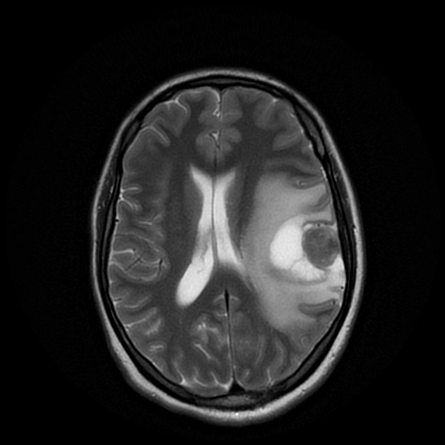 Lymphoplasmacyte-rich meningioma | Radiology Reference Article 