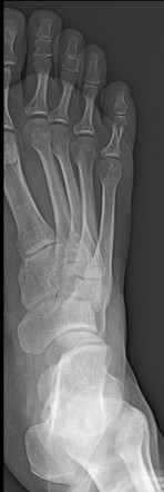 Symphalangism | Radiology Reference Article | Radiopaedia.org