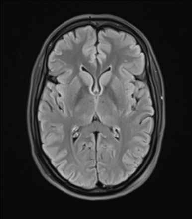 Bell palsy | Radiology Case | Radiopaedia.org