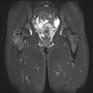 Isolated greater trochanteric fracture | Image | Radiopaedia.org