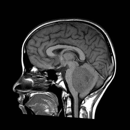 Medulloblastoma | Radiology Reference Article | Radiopaedia.org