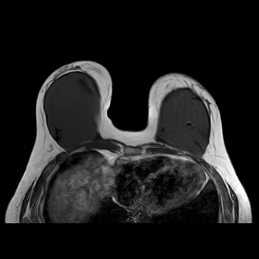 Intracapsular Breast Implant Rupture Image