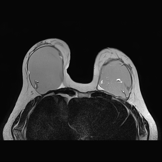 Intracapsular Breast Implant Rupture Image