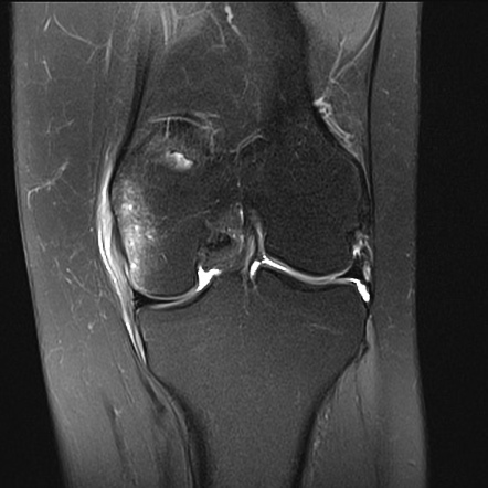 Medial collateral ligament injury | Radiology Case | Radiopaedia.org