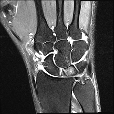 Scapholunate advanced collapse | Radiology Case | Radiopaedia.org