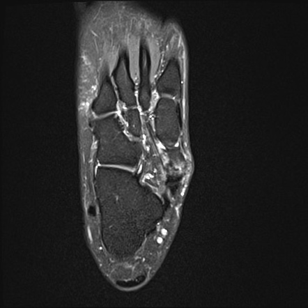 case navicular syndrome accessory radiopaedia