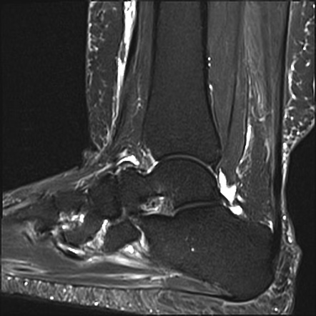 Peroneus brevis tendon tear - boomerang sign | Image | Radiopaedia.org