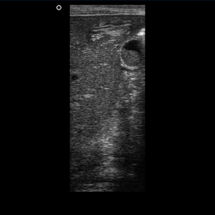 Intrahepatic ascaris worms | Radiology Case | Radiopaedia.org