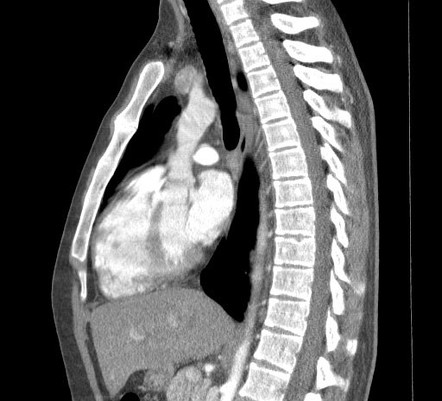 Massive cystic pulmonary hydatidosis | Image | Radiopaedia.org