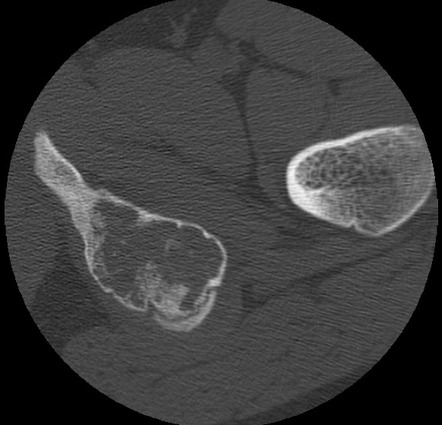 Aneurysmal Bone Cyst Mri