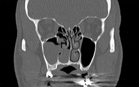 Antrochoanal Polyp | Radiology Case | Radiopaedia.org