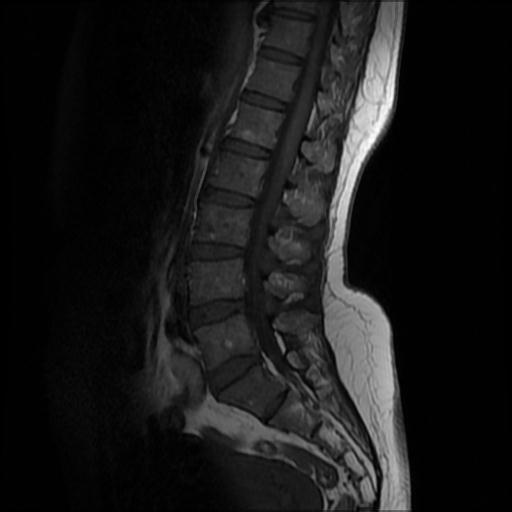 Incarcerated hemivertebra | Image | Radiopaedia.org