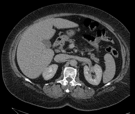 Pancreatic lipoma | Radiology Case | Radiopaedia.org