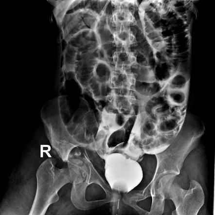 Urinary Bladder Rupture | Radiology Reference Article | Radiopaedia.org