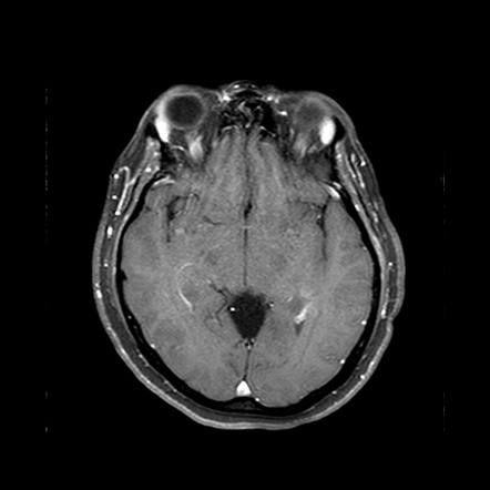 Quadrigeminal Cistern Arachnoid Cyst | Image | Radiopaedia.org