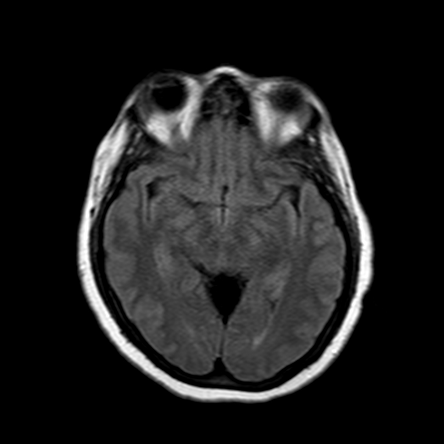 Quadrigeminal Cistern Arachnoid Cyst | Image | Radiopaedia.org