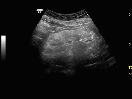 Mesenteric panniculitis | Image | Radiopaedia.org