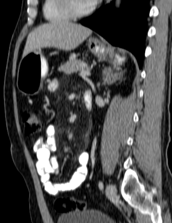 Mesenteric panniculitis | Image | Radiopaedia.org