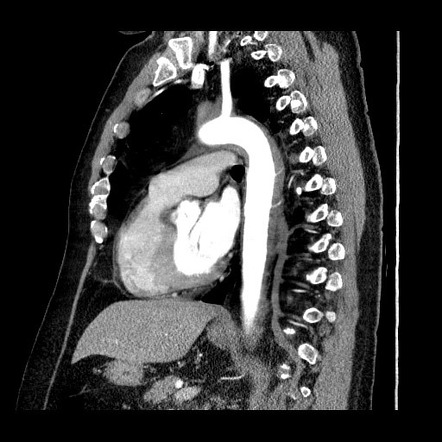 Erdheim-Chester disease | Radiology Reference Article | Radiopaedia.org