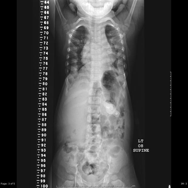 a) Cone-shaped narrow thorax; (b) Approximation of shoulders to midline