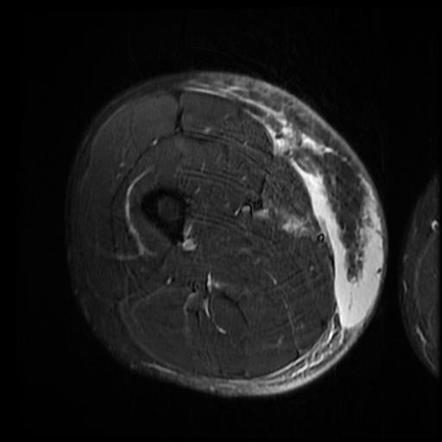 Morel-Lavallée lesion | Image | Radiopaedia.org