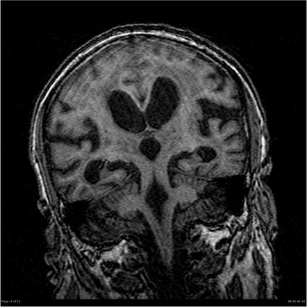 Callosal angle | Radiology Reference Article | Radiopaedia.org