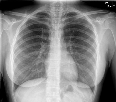 Pneumomediastinum | Radiology Case | Radiopaedia.org