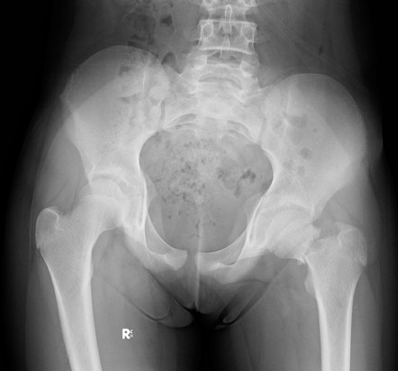 case study fracture neck of femur