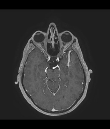 Developmental venous anomaly | Radiology Case | Radiopaedia.org