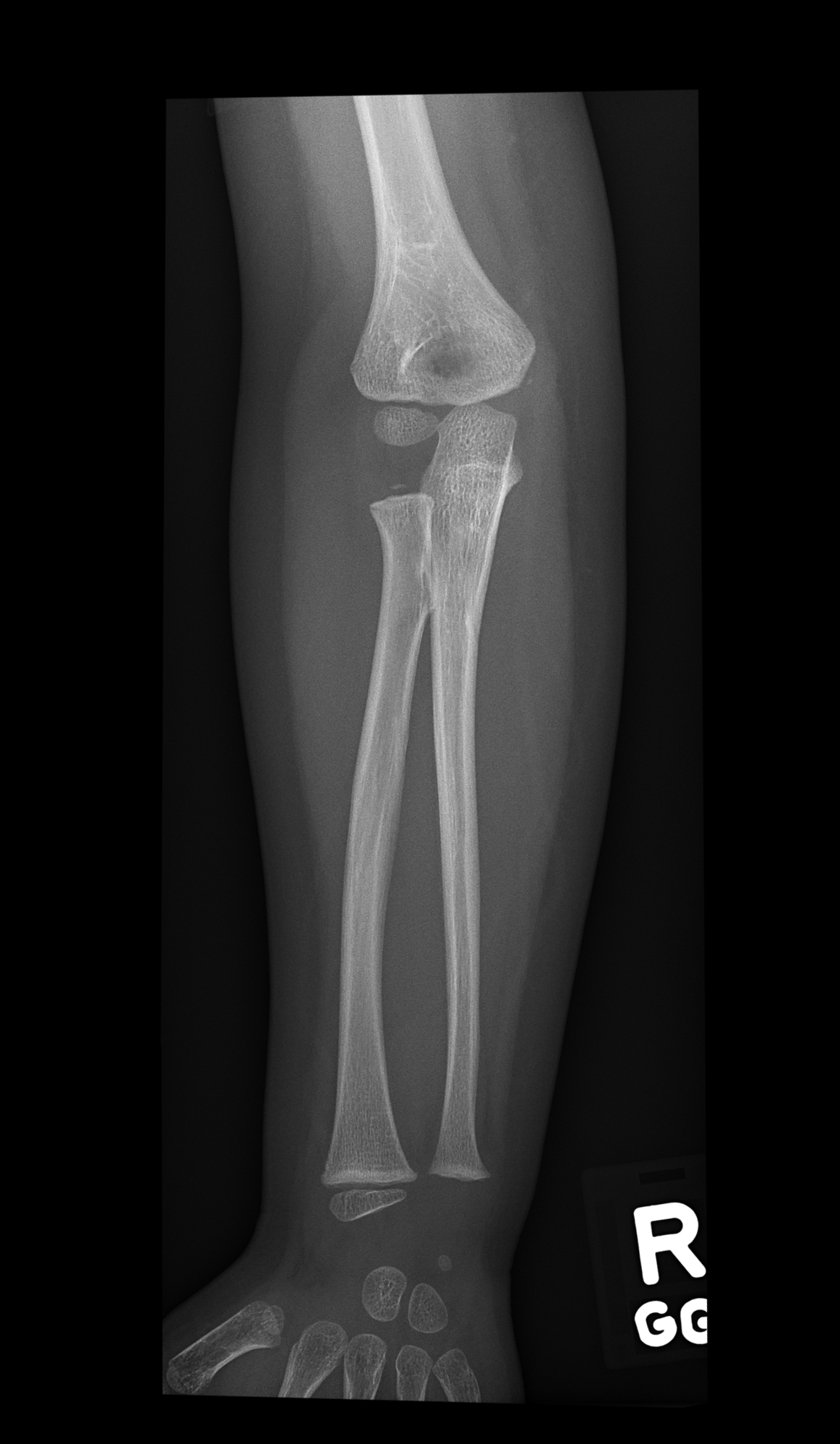 Distal humerus fracture-pediatric | Image | Radiopaedia.org