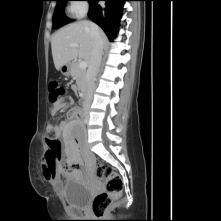 Uterine suture dehiscence with endometritis and abscess formation ...