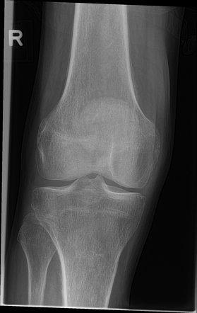 Hypertrophic osteoarthropathy | Radiology Case | Radiopaedia.org