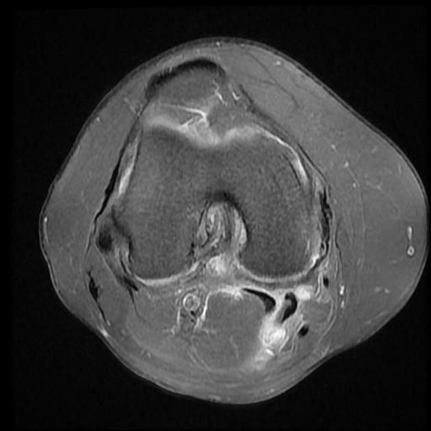 Medial collateral ligament injury grading