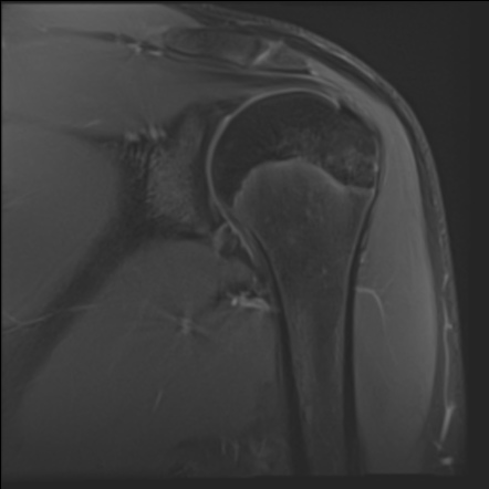 Perthes lesion | Radiology Case | Radiopaedia.org