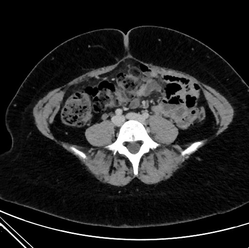 Epigastric Hernia Image