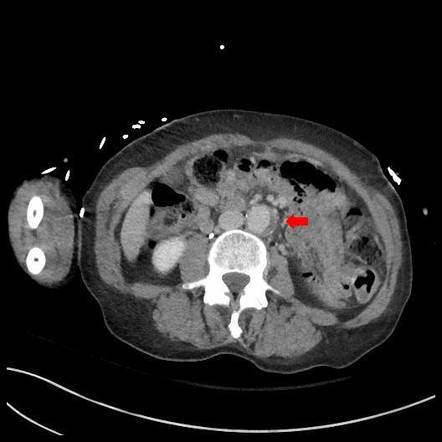 Infrarenal atheromatous plaque with ulceration (PET-CT) | Image ...