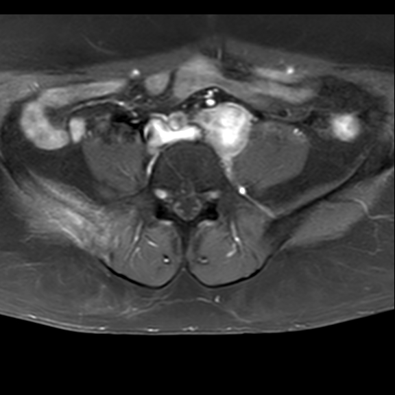 Metastasis on routine lumbar spine MRI | Image | Radiopaedia.org